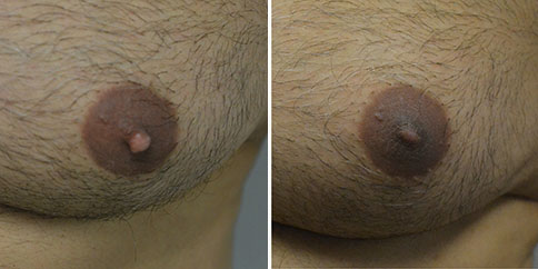 Nipple Reduction – Patient 110  Jonathan Hall, MD, FACSJonathan Hall, MD,  FACS