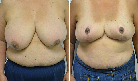 Breast Reduction & Asymmetry Patient – 175  Jonathan Hall, MD,  FACSJonathan Hall, MD, FACS