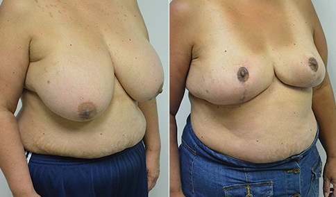 46 Years Old - 40j to 40c/d - Breast Reduction Journey 