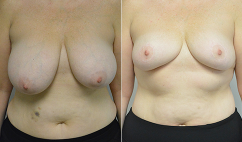 Breast Reduction (TRIPLE D BREASTS)