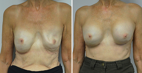 Nipple Reduction – Patient 110  Jonathan Hall, MD, FACSJonathan Hall, MD,  FACS