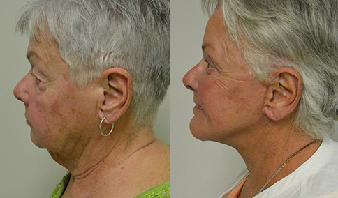 Facelift – Patient 125  Jonathan Hall, MD, FACSJonathan Hall, MD