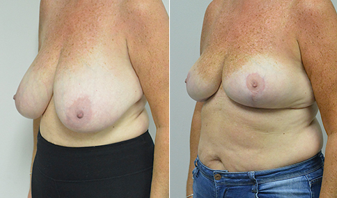 Woman Gets Breast Reduction From '36NNN' To Double-D