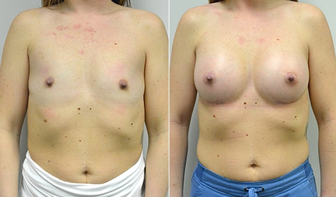 Breast Augmentation Complications - Double Bubble and More