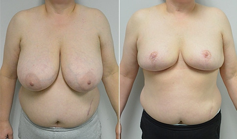 Breast Reduction – Patient 145  Jonathan Hall, MD, FACSJonathan