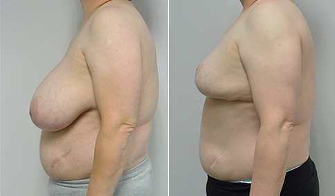 Breast Problems - Before and after