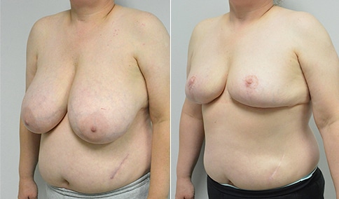 Epic Breast Reduction!!, DDD TO C Cup