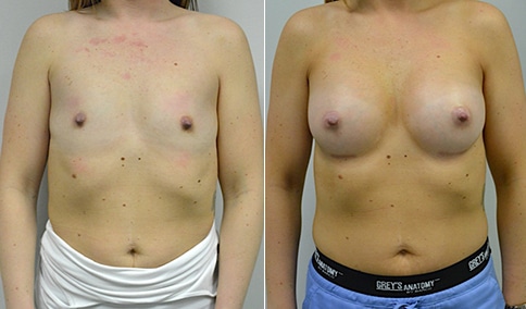 Breast Augmentation – Patient 278