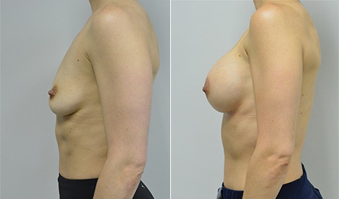 Breast Augmentation  Jonathan Hall, MD, FACS- Part 4Jonathan Hall, MD, FACS