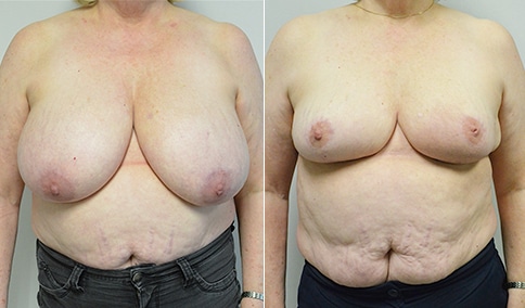 Breast Reduction – Patient 165  Jonathan Hall, MD, FACSJonathan Hall, MD,  FACS