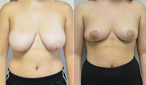 Breast Reduction – Patient 167  Jonathan Hall, MD, FACSJonathan Hall, MD,  FACS