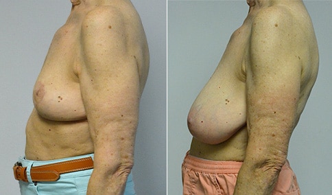 Breast Reduction Patient #125  Jonathan Hall, MD, FACSJonathan Hall, MD,  FACS