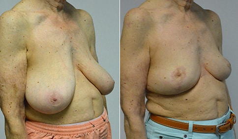 Breast Reduction & Asymmetry Patient – 175  Jonathan Hall, MD,  FACSJonathan Hall, MD, FACS