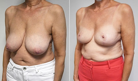 Breast Reduction Patient – 176  Jonathan Hall, MD, FACSJonathan Hall, MD,  FACS