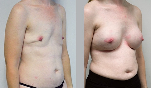 Lumpectomy Before & Afters Patient 01