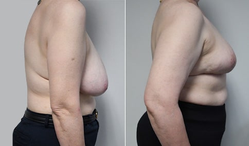 Breast Reduction Patient #125  Jonathan Hall, MD, FACSJonathan Hall, MD,  FACS