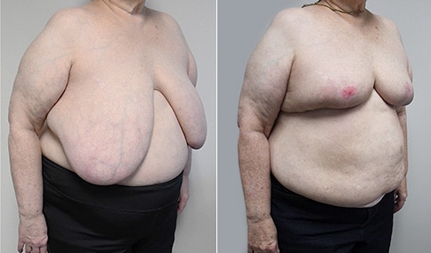 Breast Reduction (TRIPLE D BREASTS)  Greenberg Cosmetic Surgery 