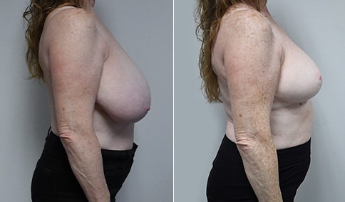 Breast Reduction – Patient 120  Jonathan Hall, MD, FACSJonathan