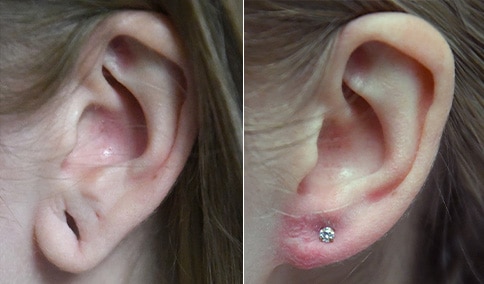 Gauged Ear/Earlobe Repair – Patient 222