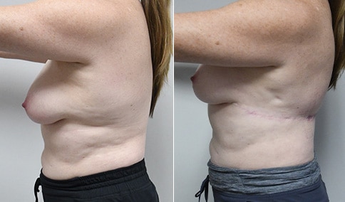 Bra Line Back Lift Before & After Photos