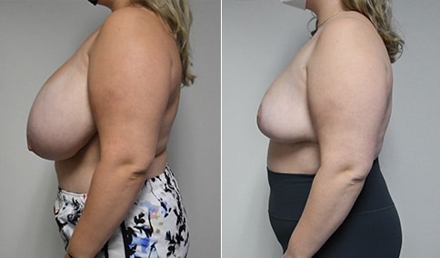 https://www.drjhall.com/wp-content/uploads/2022/01/Hall_Boston_Breast-Reduction-92-Left-LAT.jpg