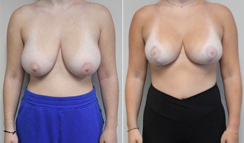 Breast Reduction Patient #125  Jonathan Hall, MD, FACSJonathan Hall, MD,  FACS